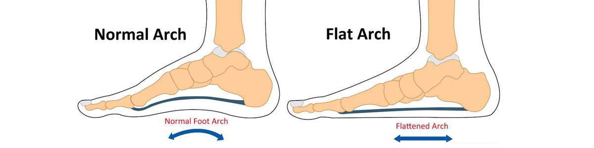 Flat Feet: More Than Just Foot Pain Flat Feet: More Than Just Foot Pain